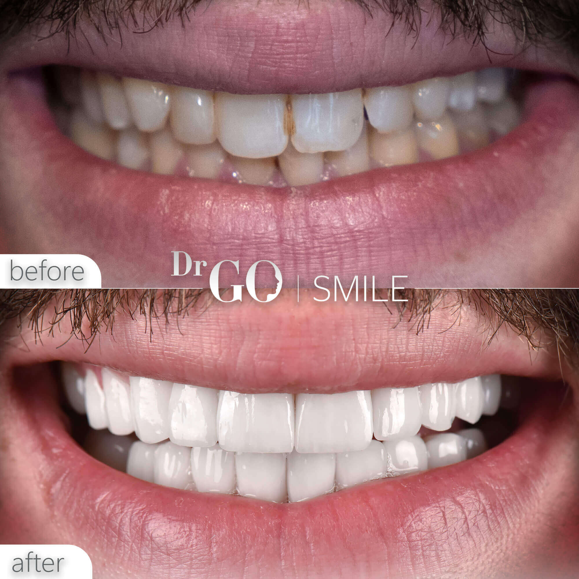 Drgo Smile Before After 1