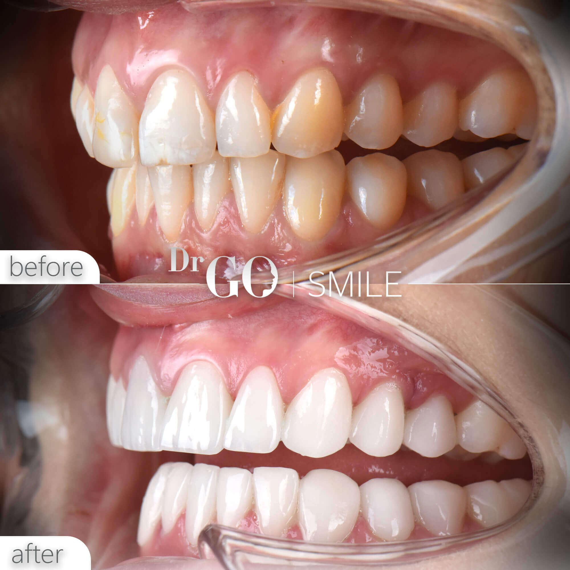Drgo Smile Before After 10