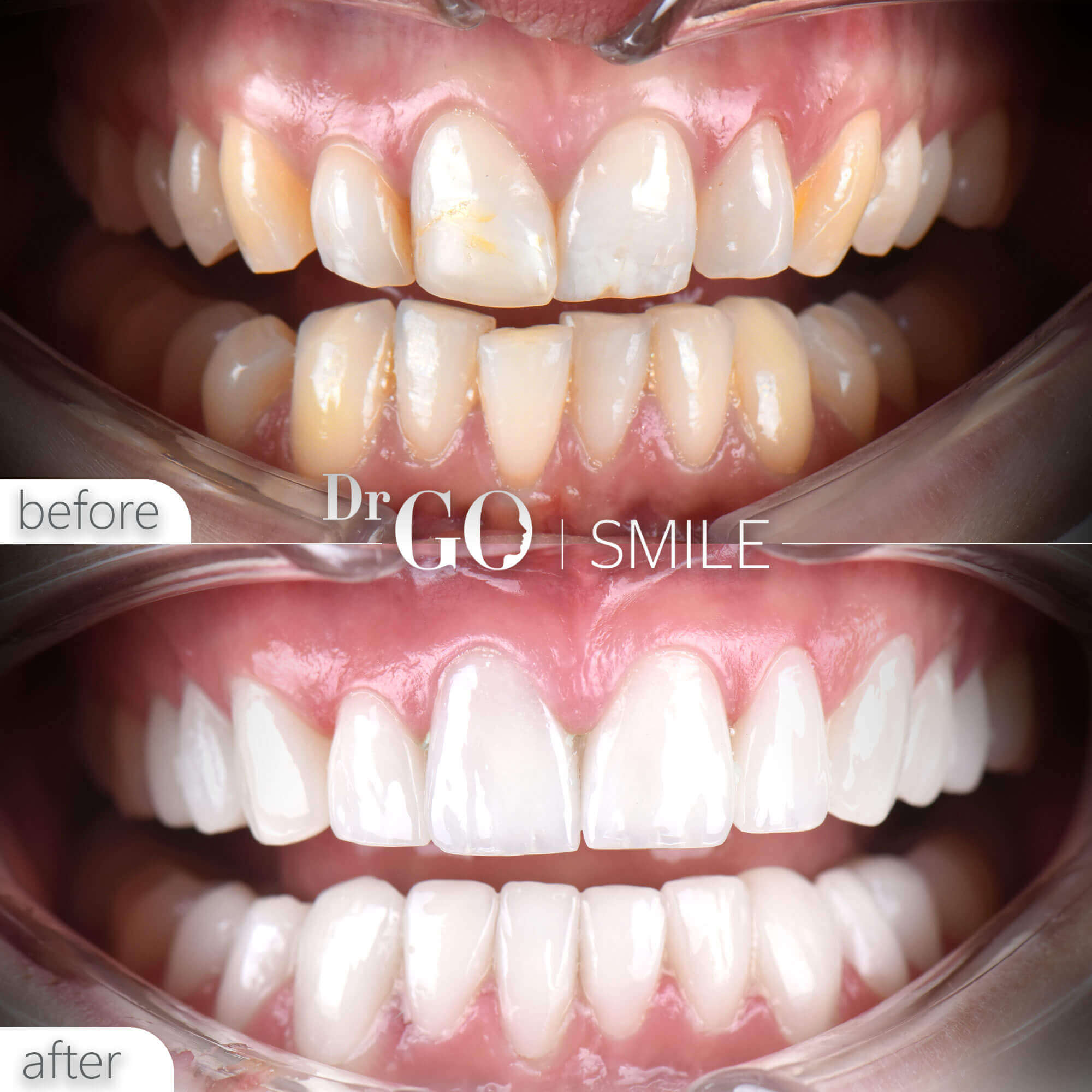 Drgo Smile Before After 11