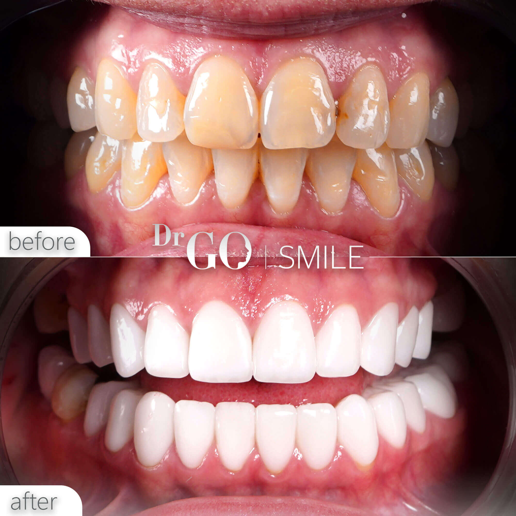 Drgo Smile Before After 18