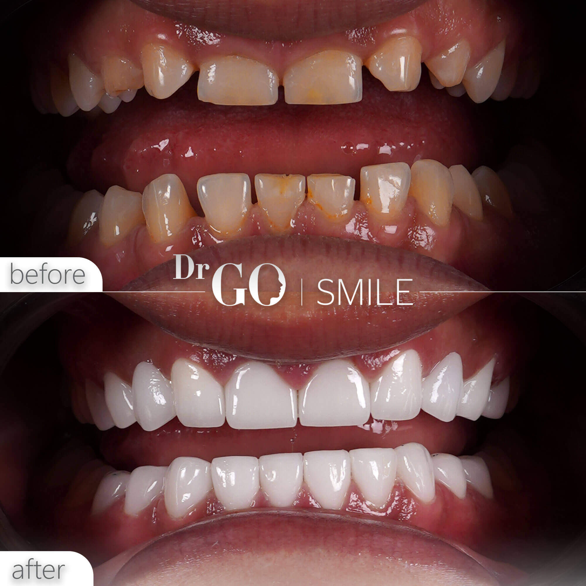 Drgo Smile Before After 4