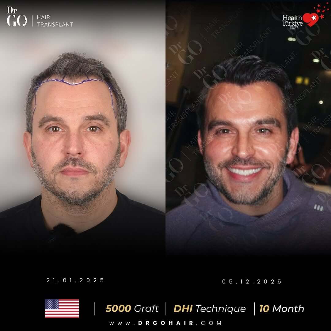 hair transplant in turkey