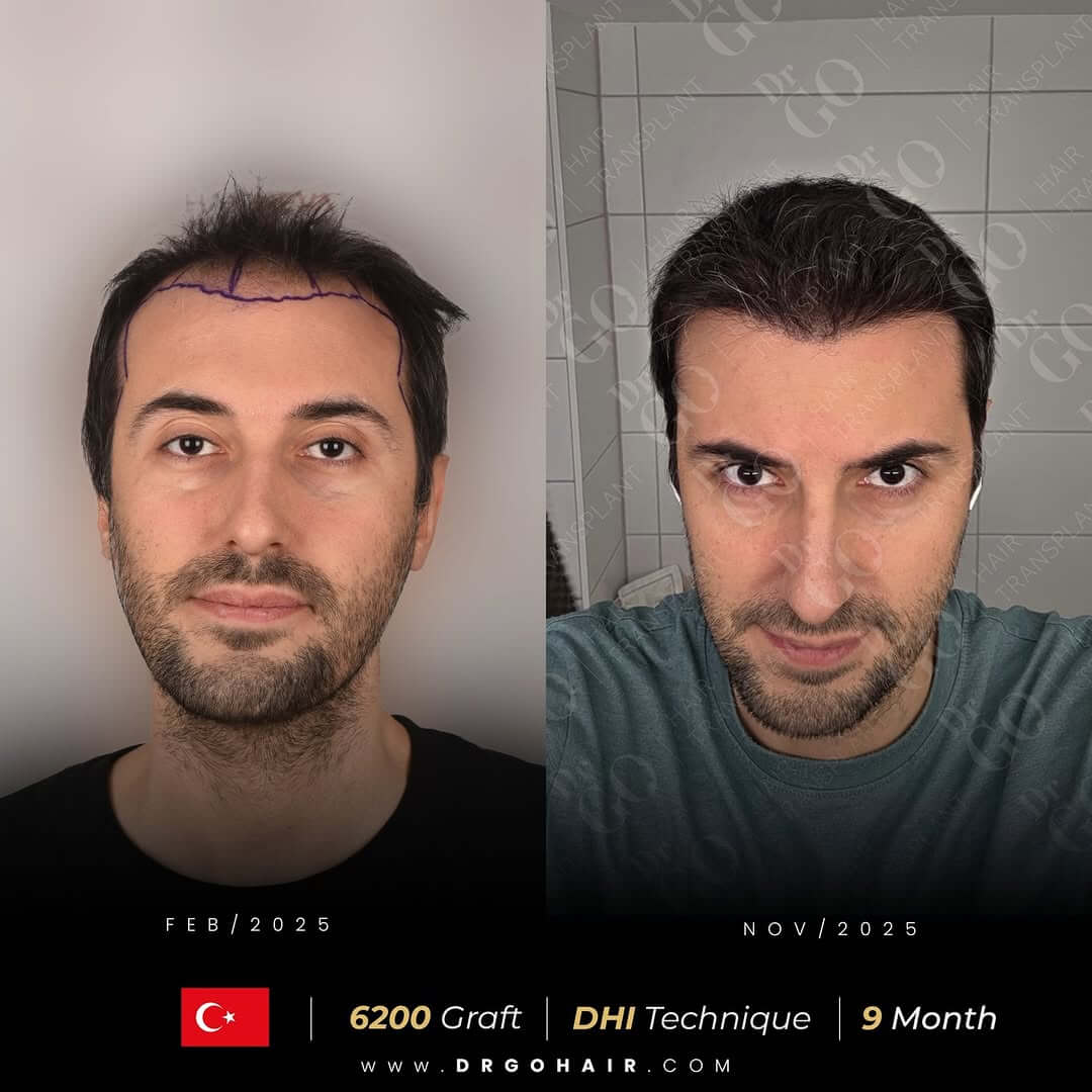 hair transplant in turkey1