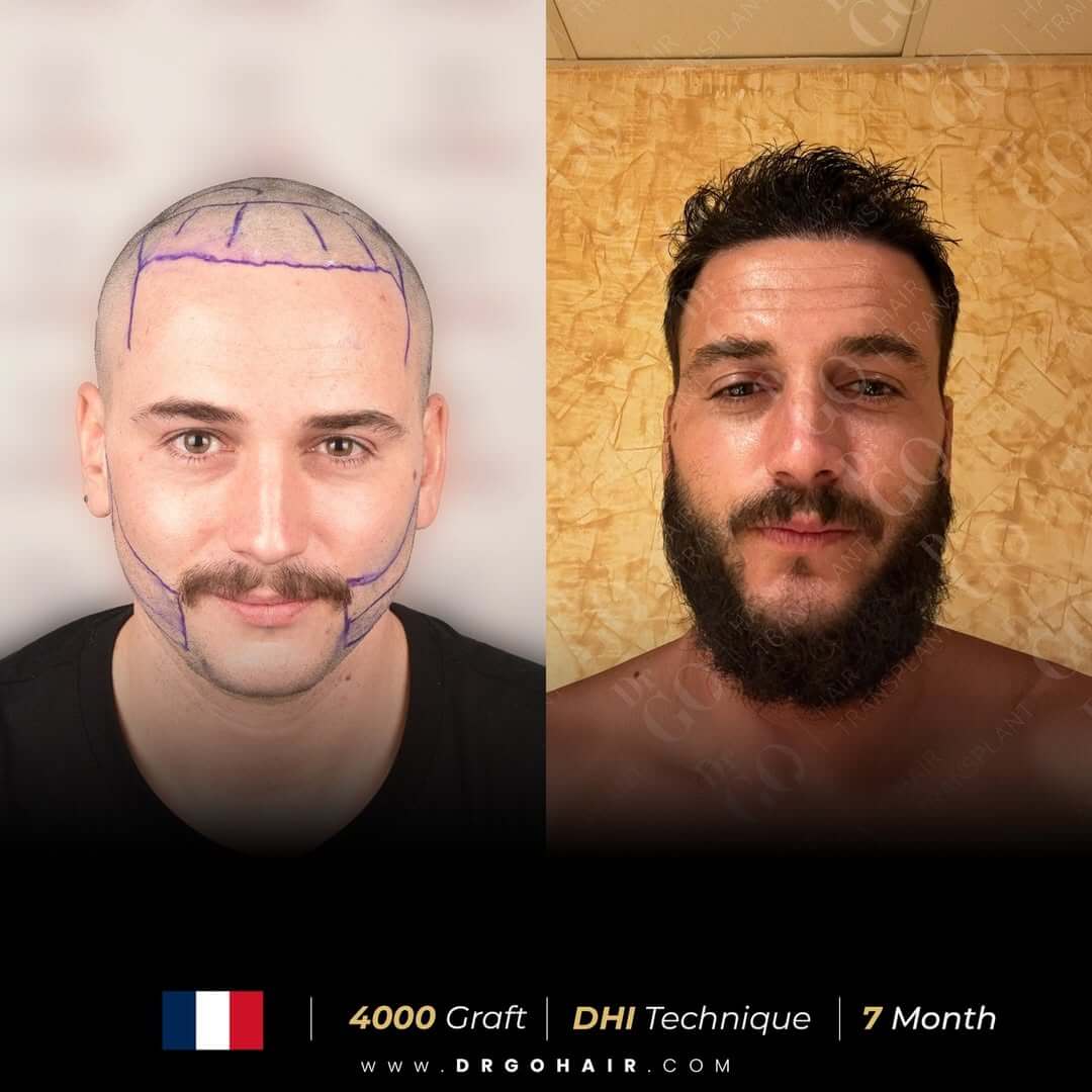 hair transplant in turkey2