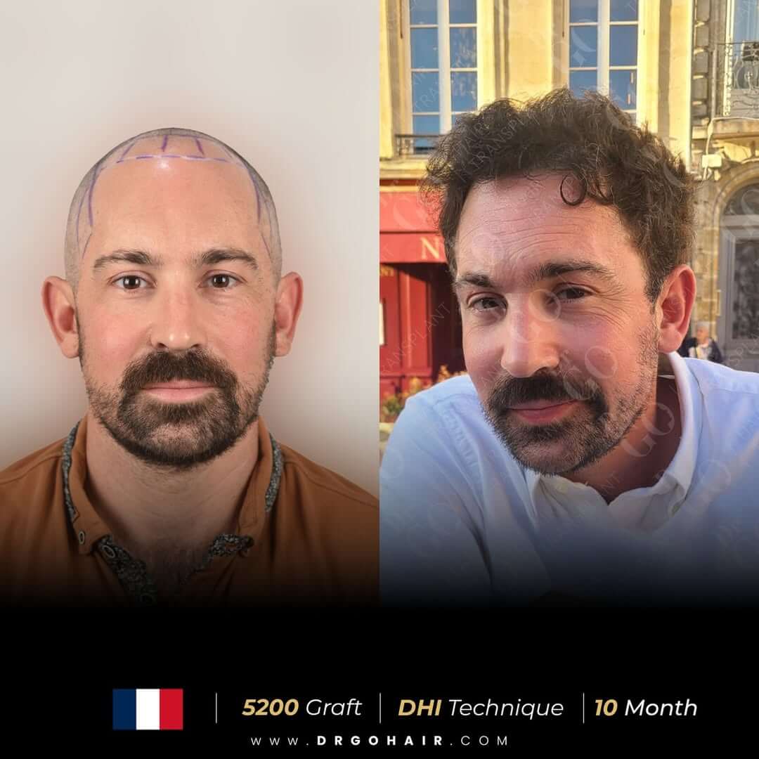 hair transplant in turkey3