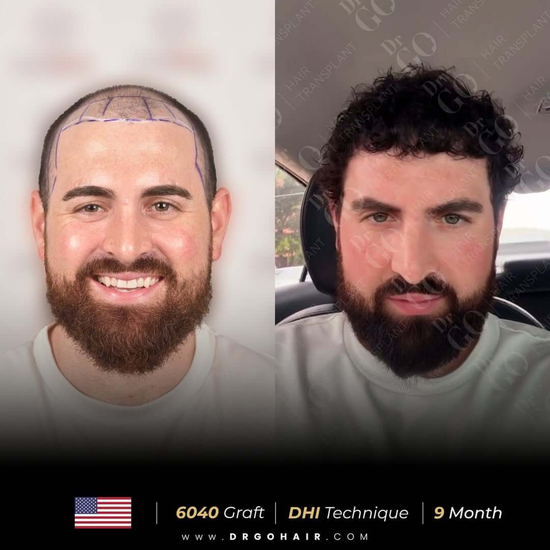 hair transplant in turkey4