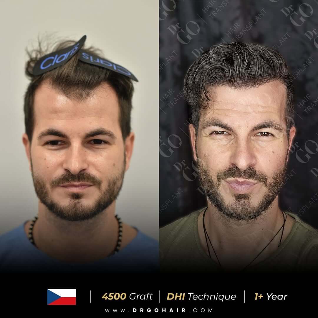 hair transplant in turkey5