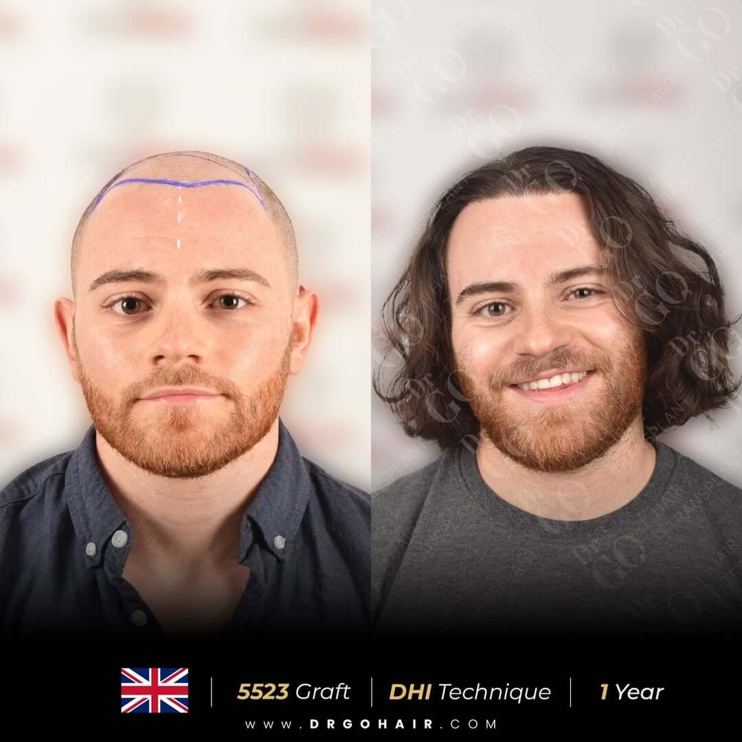 hair transplant in turkey6