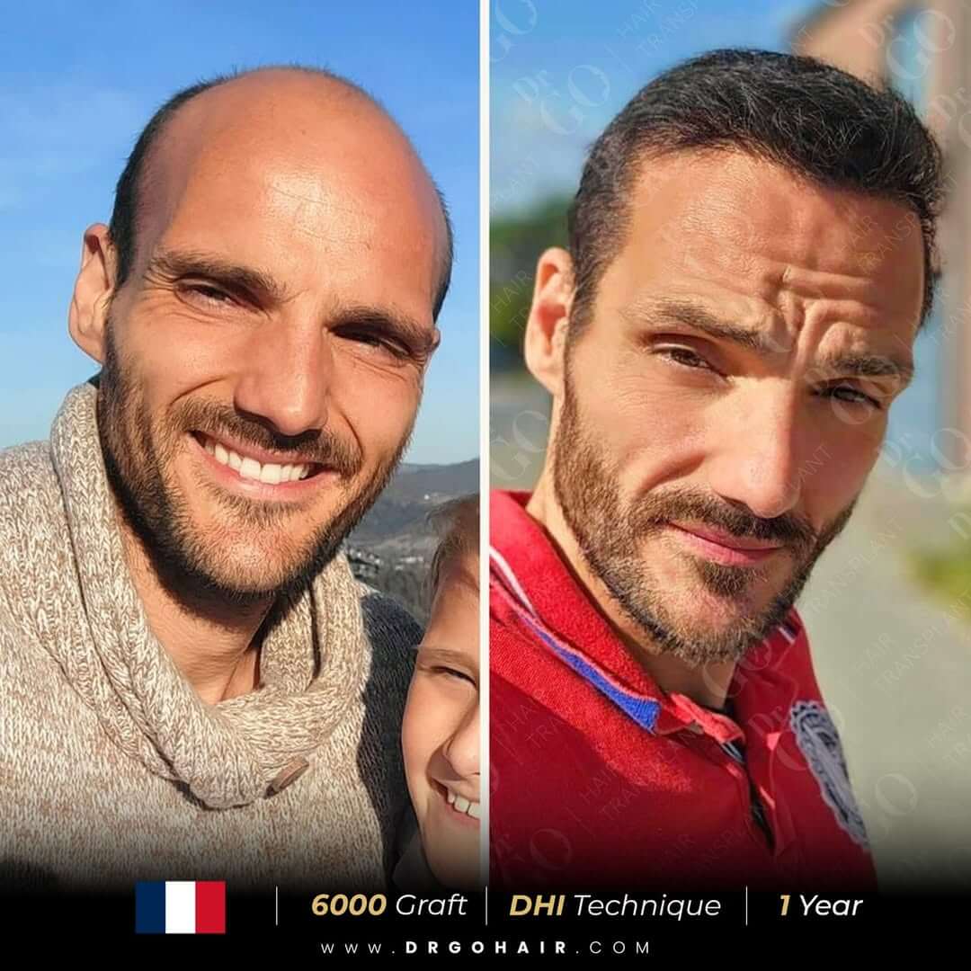 hair transplant in turkey7