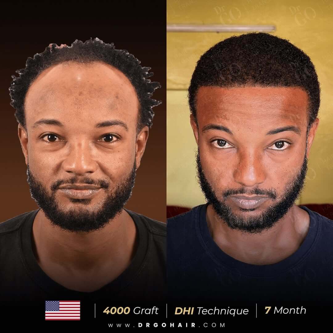 hair transplant in turkey8