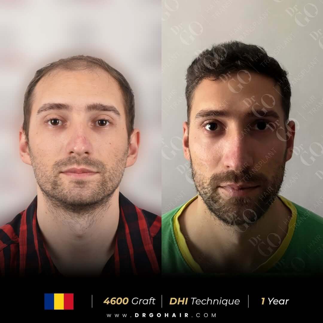 hair transplant in turkey9