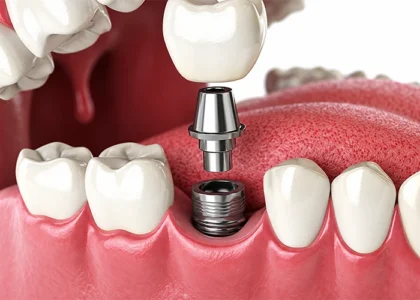 Dental Implant