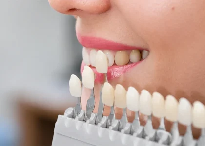 E-Max Veneers