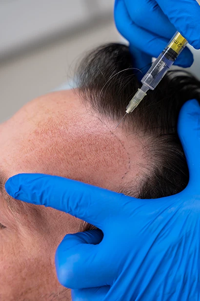 FUE Hair Transplant