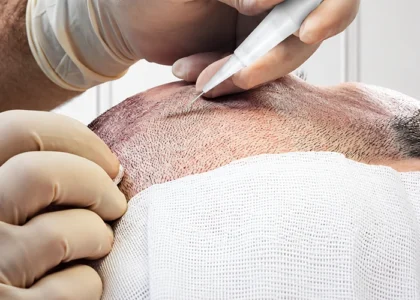 DHI Hair Transplant