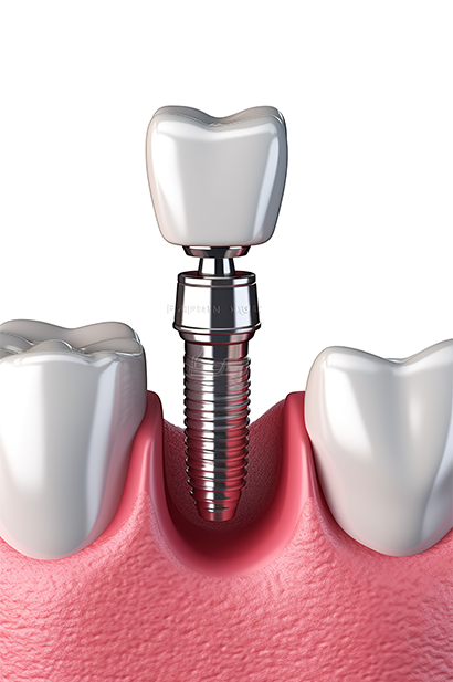 Dental Implant