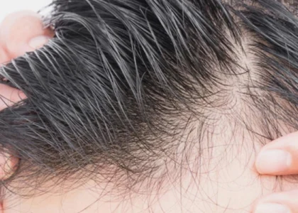 Unshaven Hair Transplant